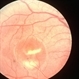 Best's disease